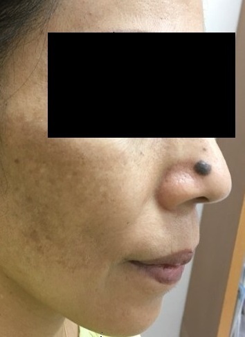 ⭐︎ ほくろ ⭐︎ ほくろを取ると、がんになる」って本当？ セルフチェックのポイントを